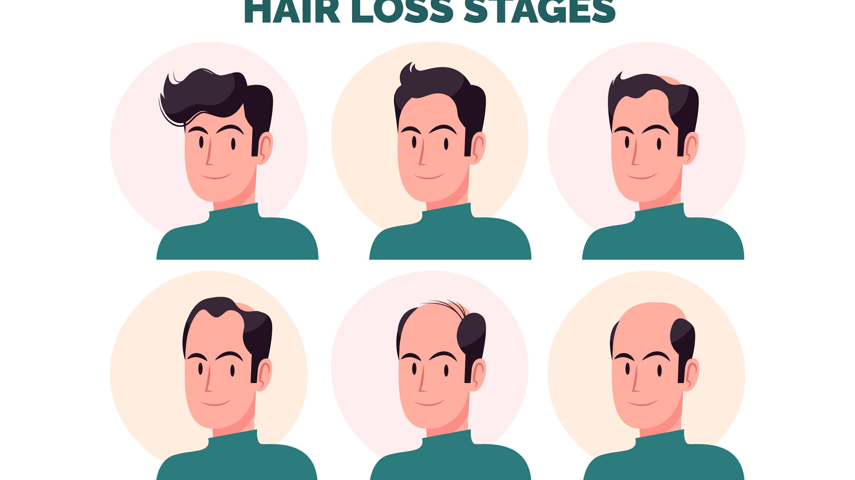 Die Stufen von erblich bedingtem Haarausfall