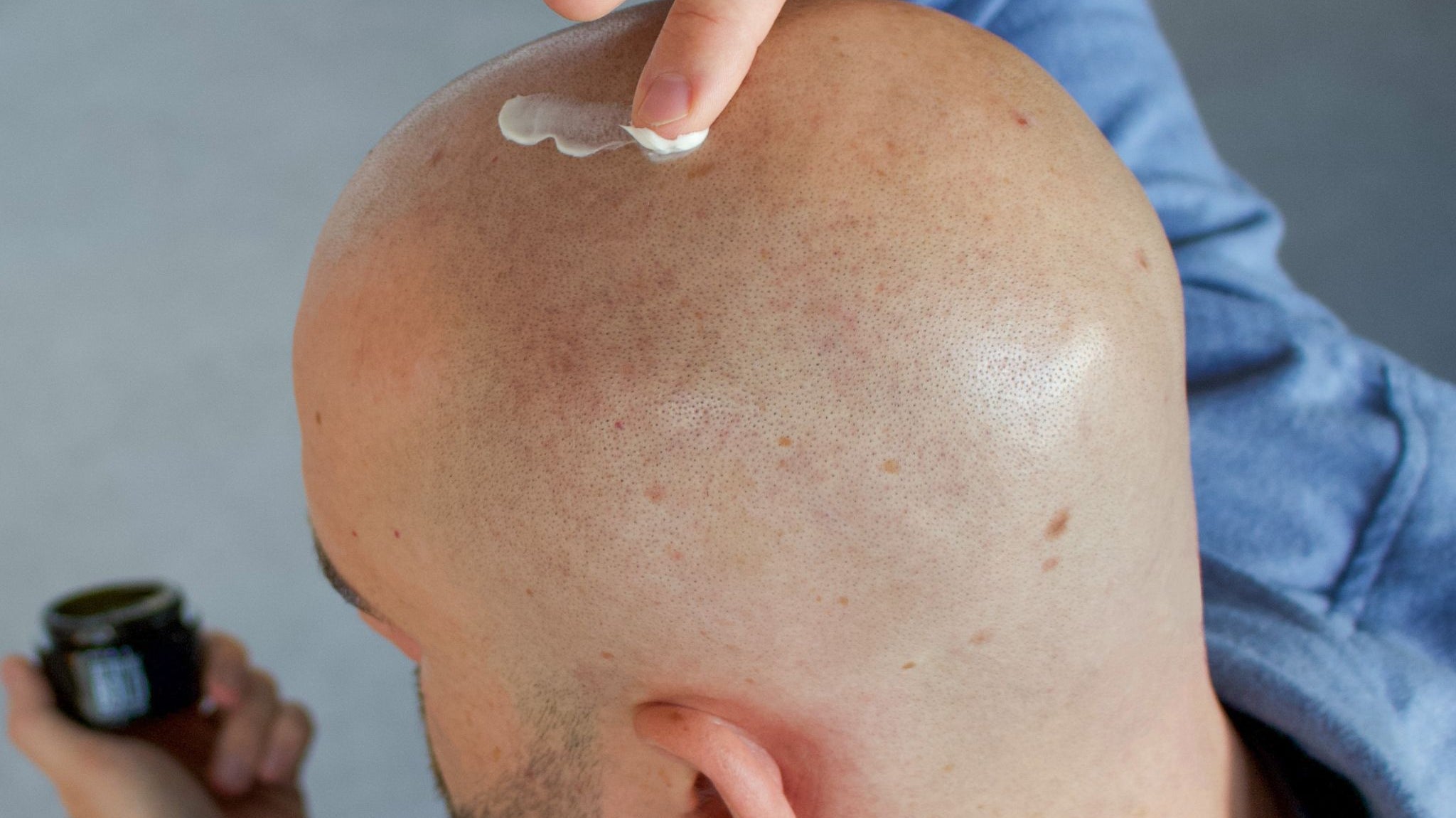 Mann cremt sich die Glatze mit der Glatzencreme ein