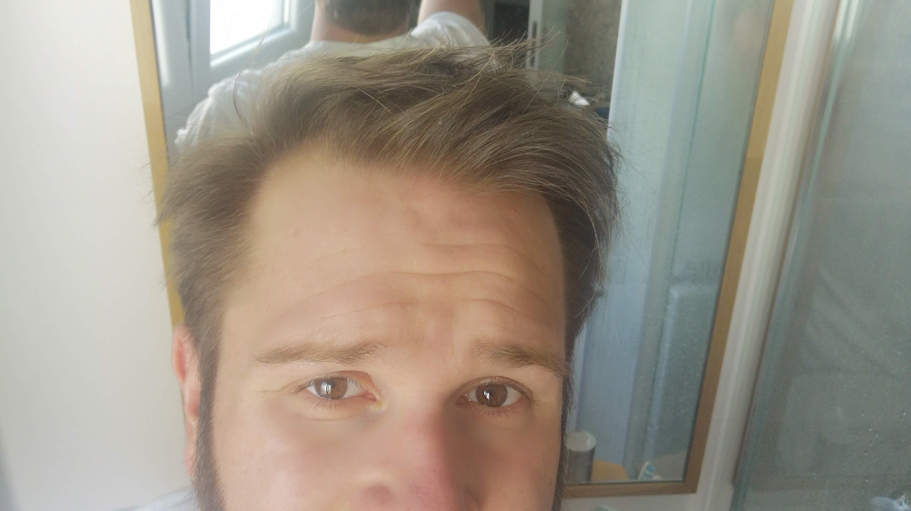 Die Ursachen von Haarausfall und Glatze – Ein umfassender Leitfaden für Betroffene