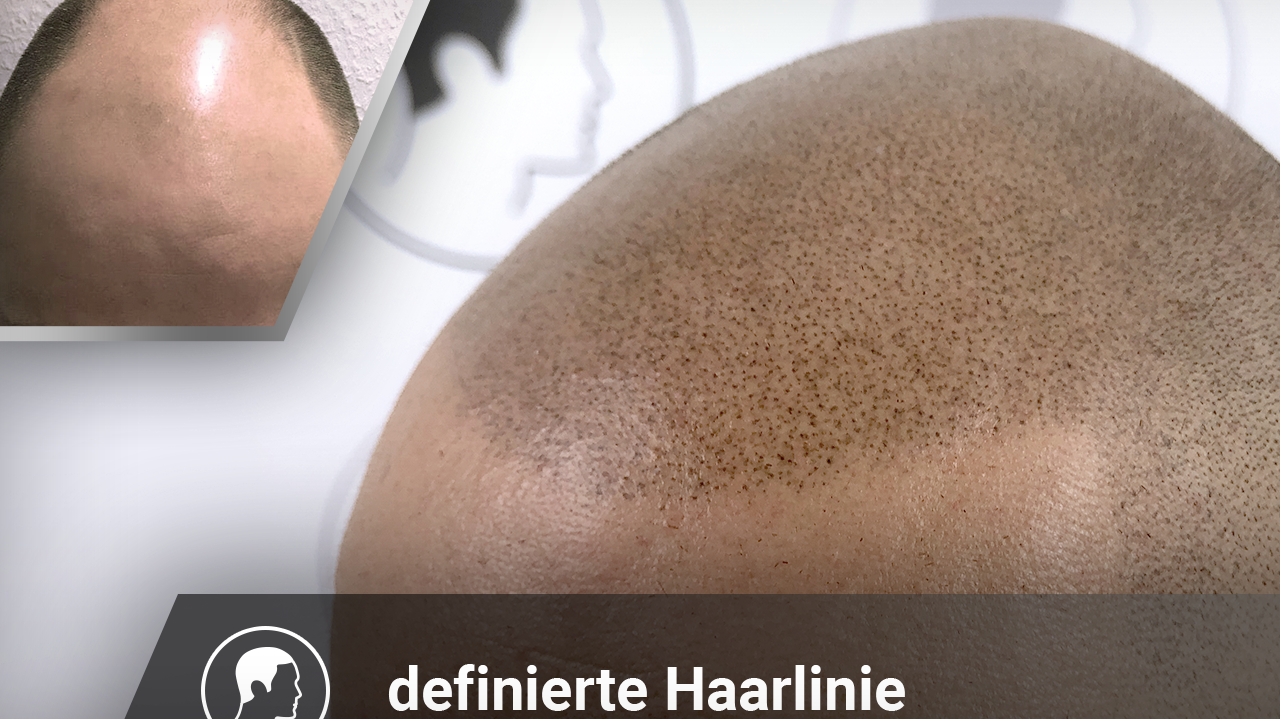 Haarpigmentierung, definierte Haarlinie