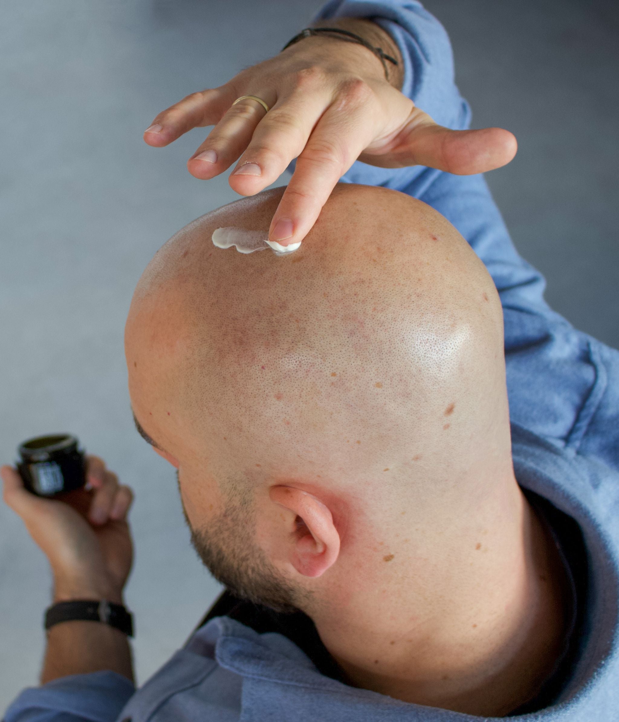 Keine Haare, keine Probleme? Warum Glatzenträger trotzdem mit Herausforderungen kämpfen
