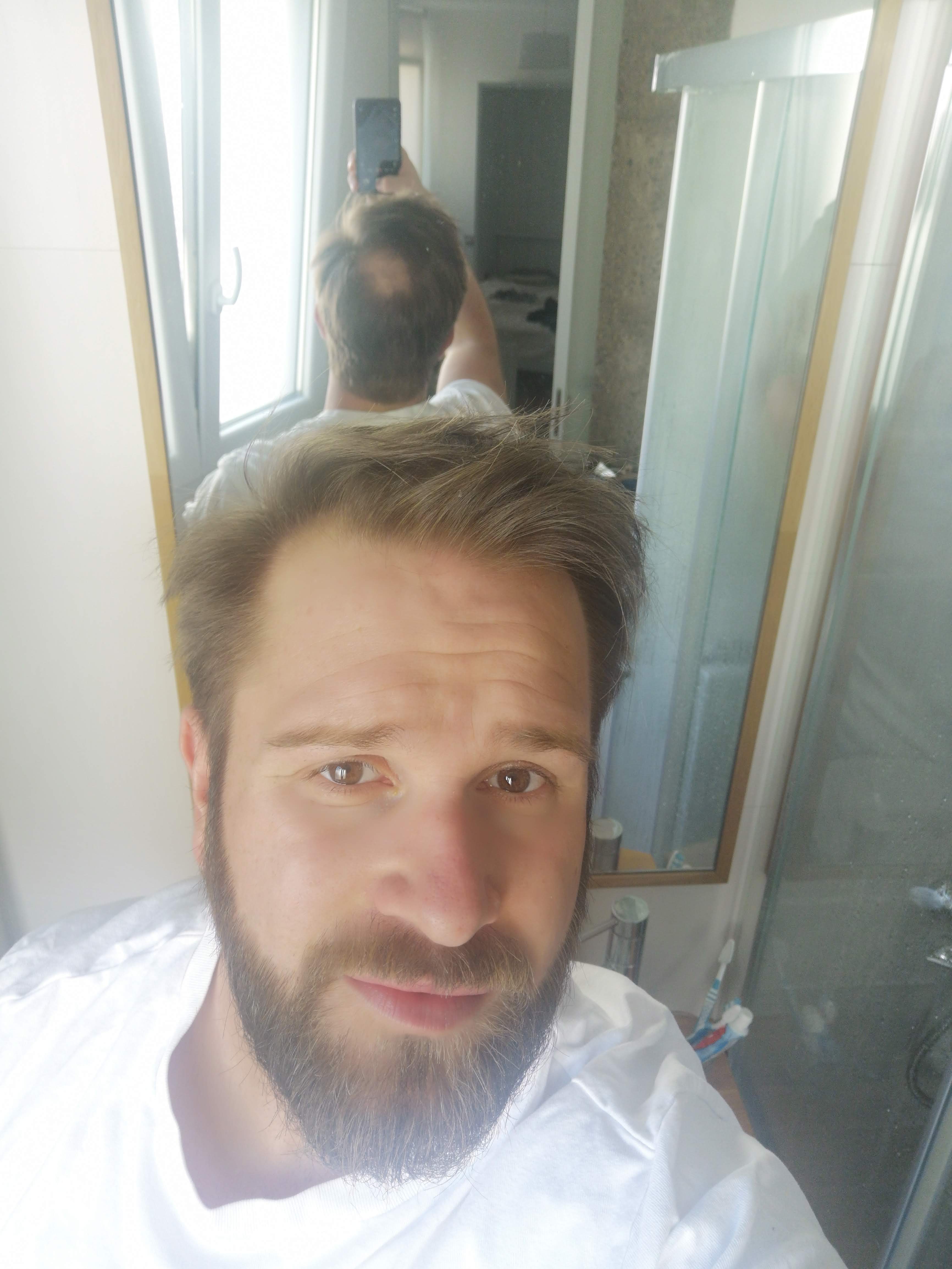 Die Ursachen von Haarausfall und Glatze – Ein umfassender Leitfaden für Betroffene