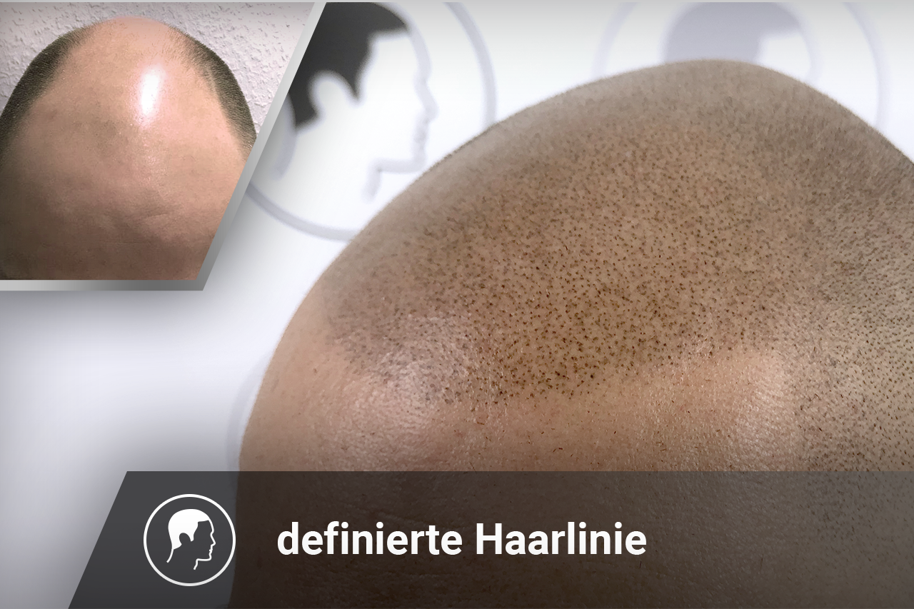 Haarpigmentierung, definierte Haarlinie