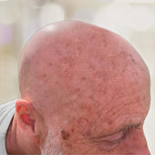 Pigment- und Altersflecken