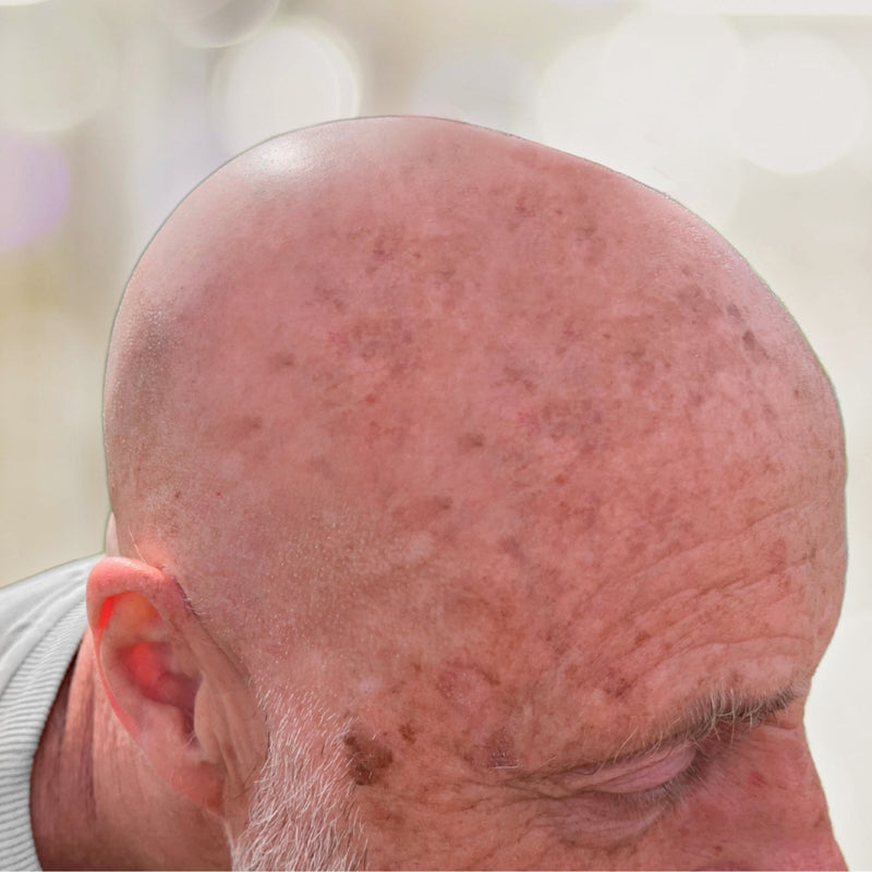 Pigment- und Altersflecken